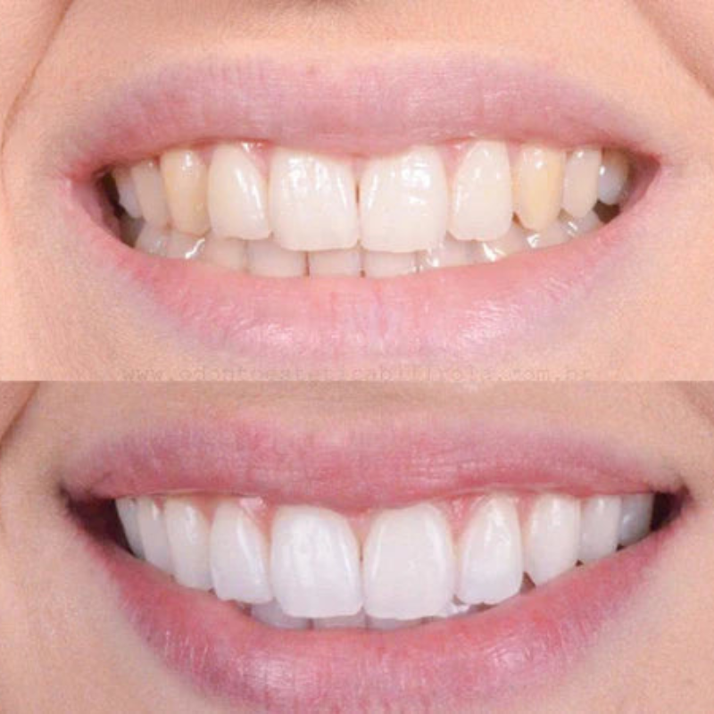 Hurtig tandblegning for et strålende smil